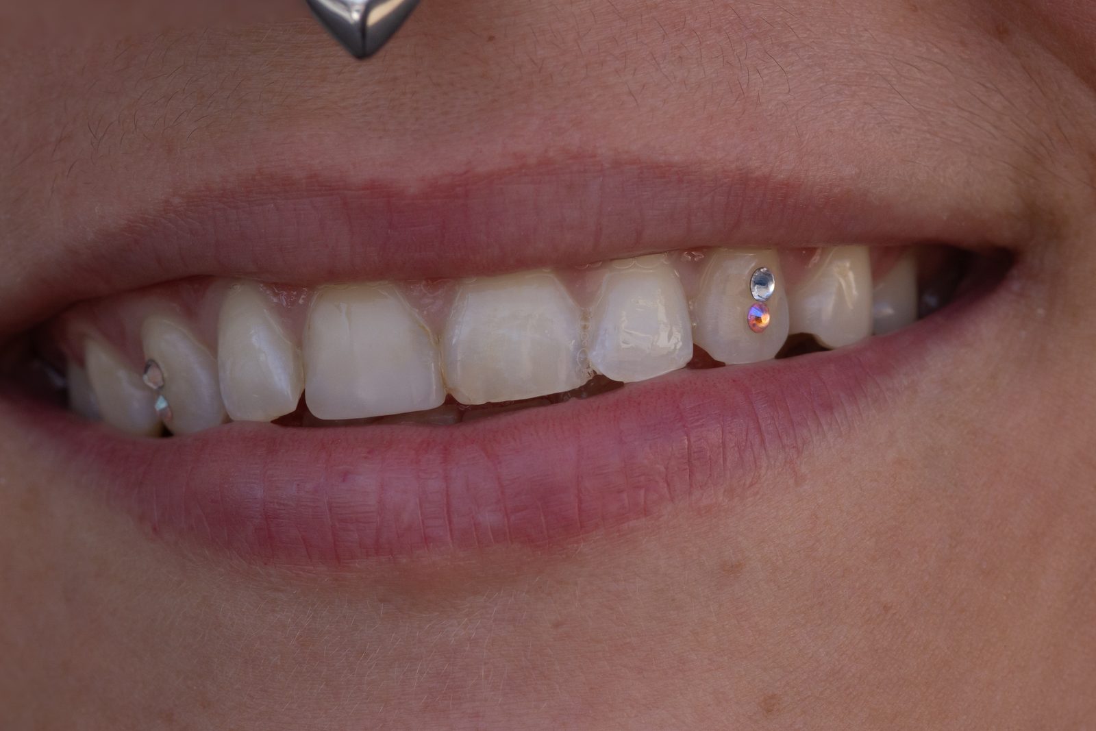 Tooth Gems Multi